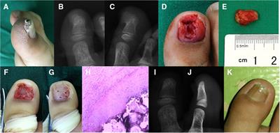 Clinical diagnosis and treatment of subungual exostosis in children